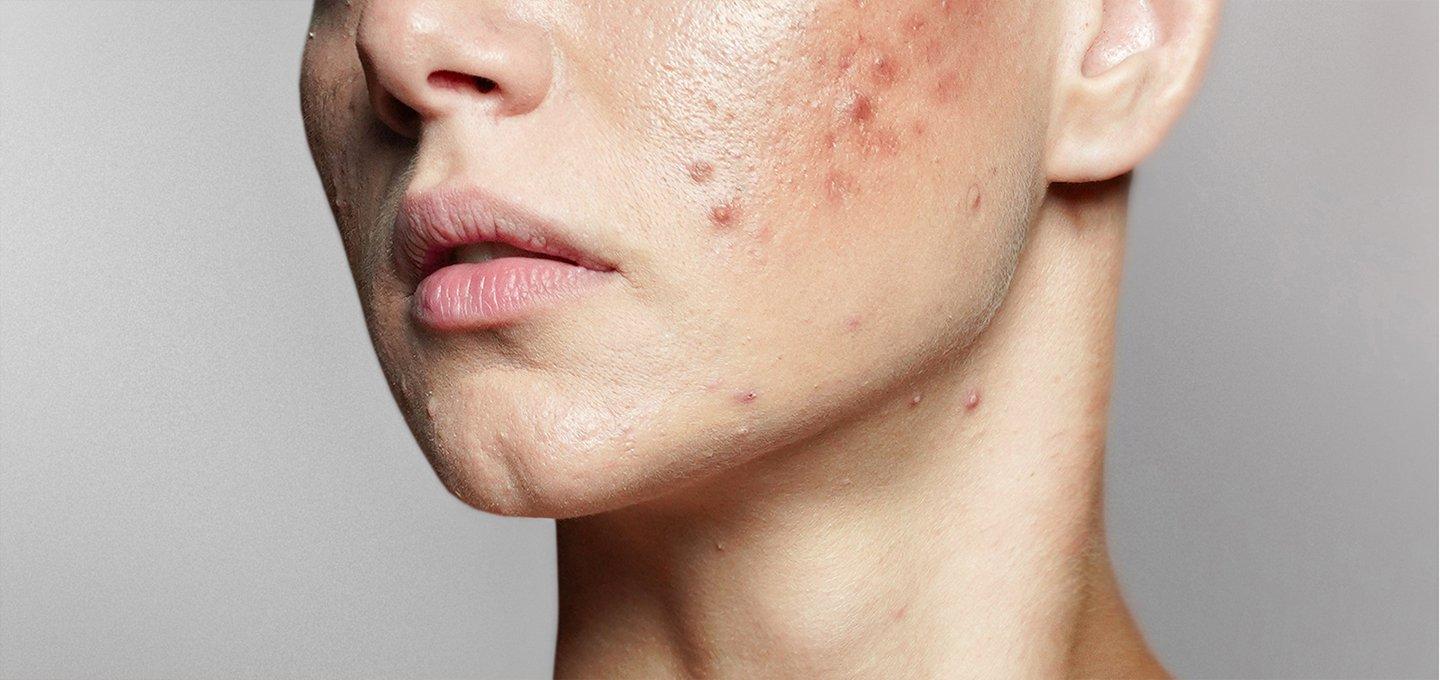 Close-up of a person's face with visible acne and blemishes on the cheeks