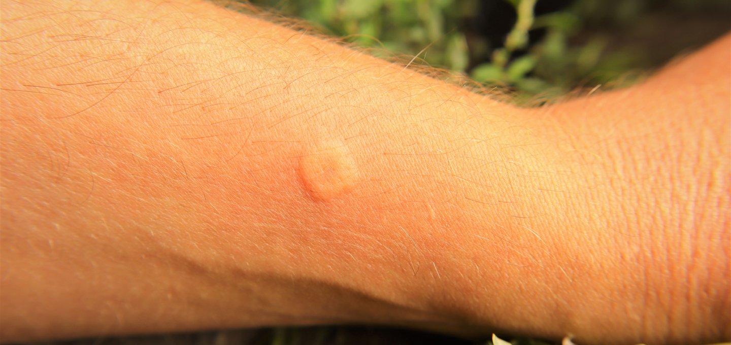Bee vs. wasp sting: how to tell the difference and treat it