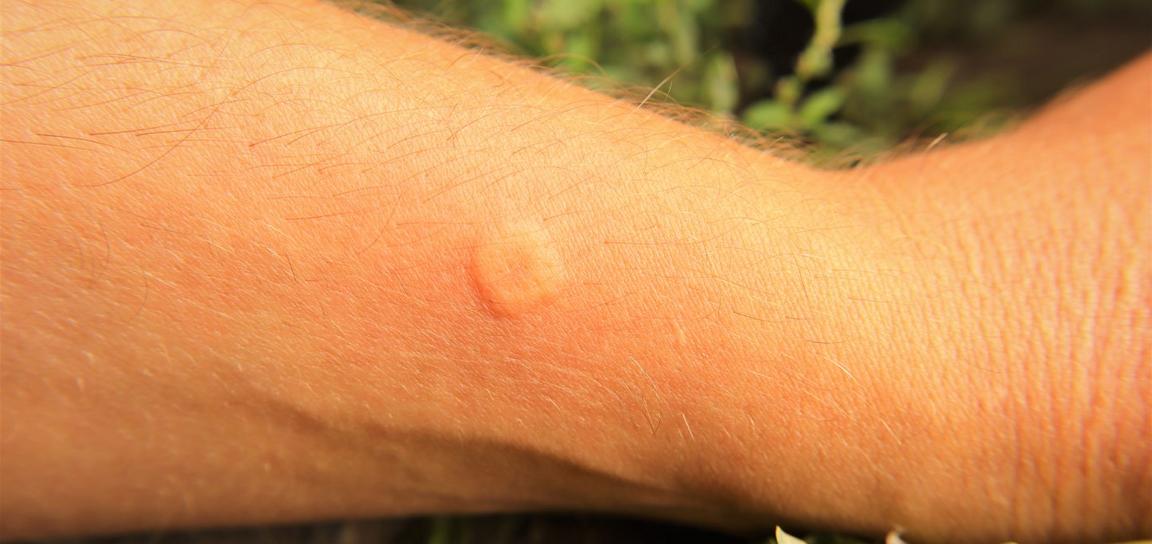 Close-up of a light tan forearm with a small, oval, pinkish lesion on the skin against a blurred green background.