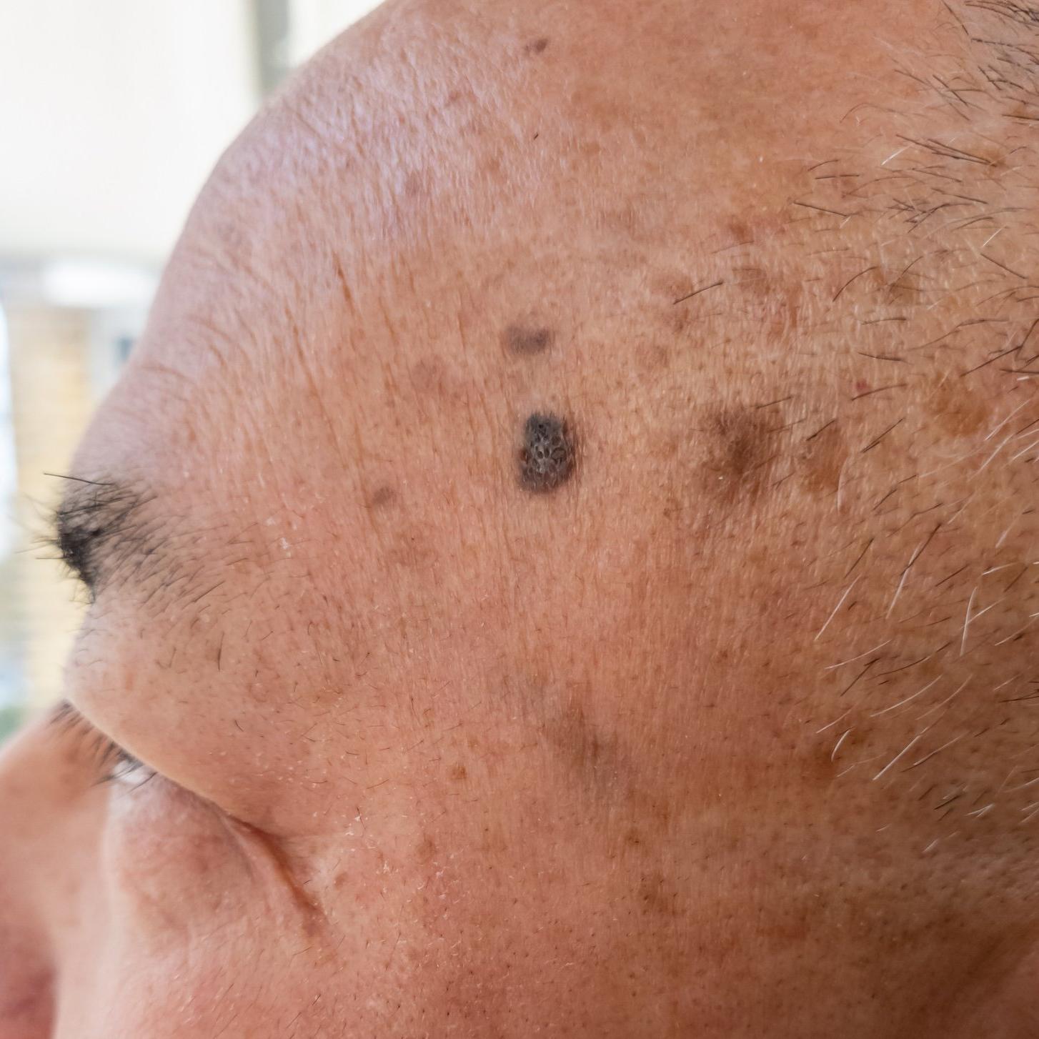 A close up of mole on somebody's head