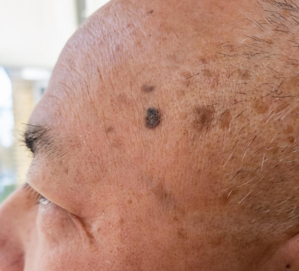 The side profile of the top of a man's head with moles