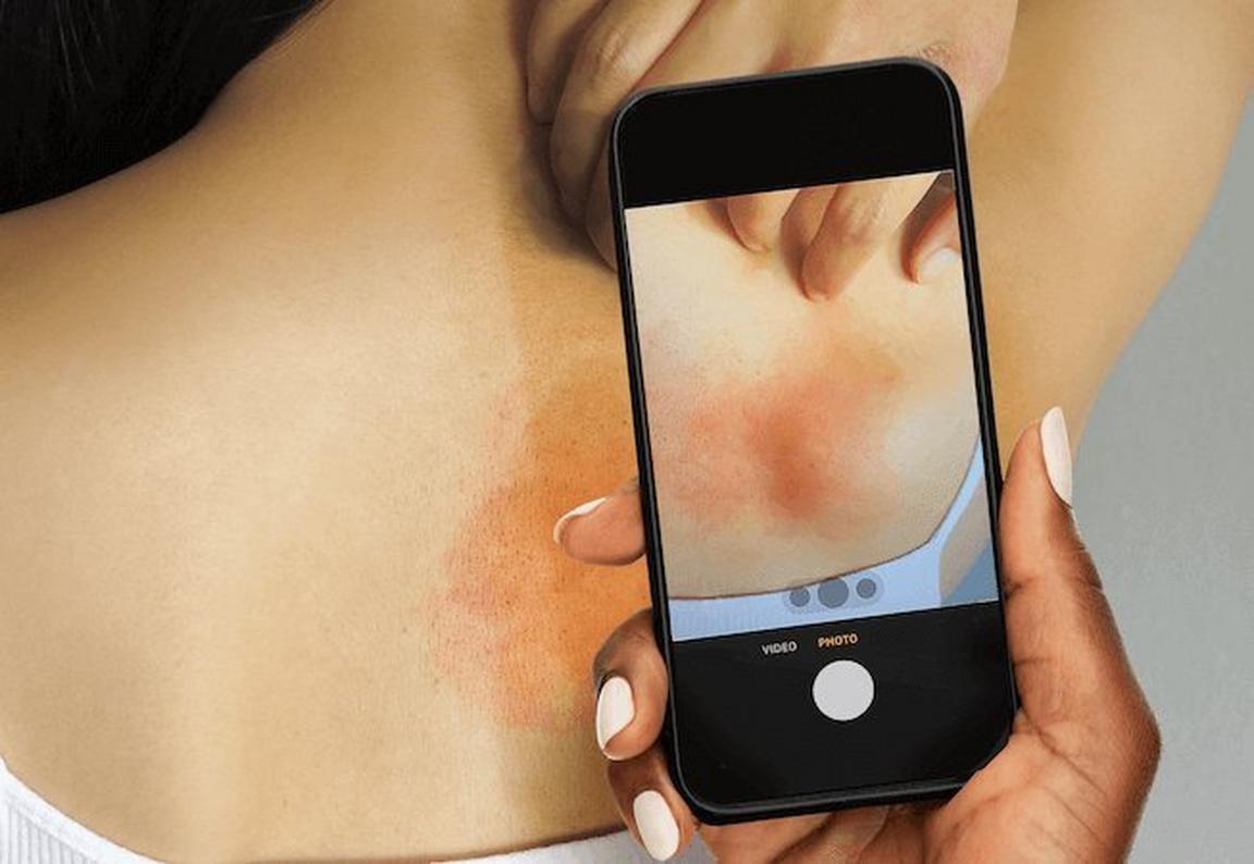 Illustration of a smartphone displaying a rash on someones body, surrounded by decorative stars