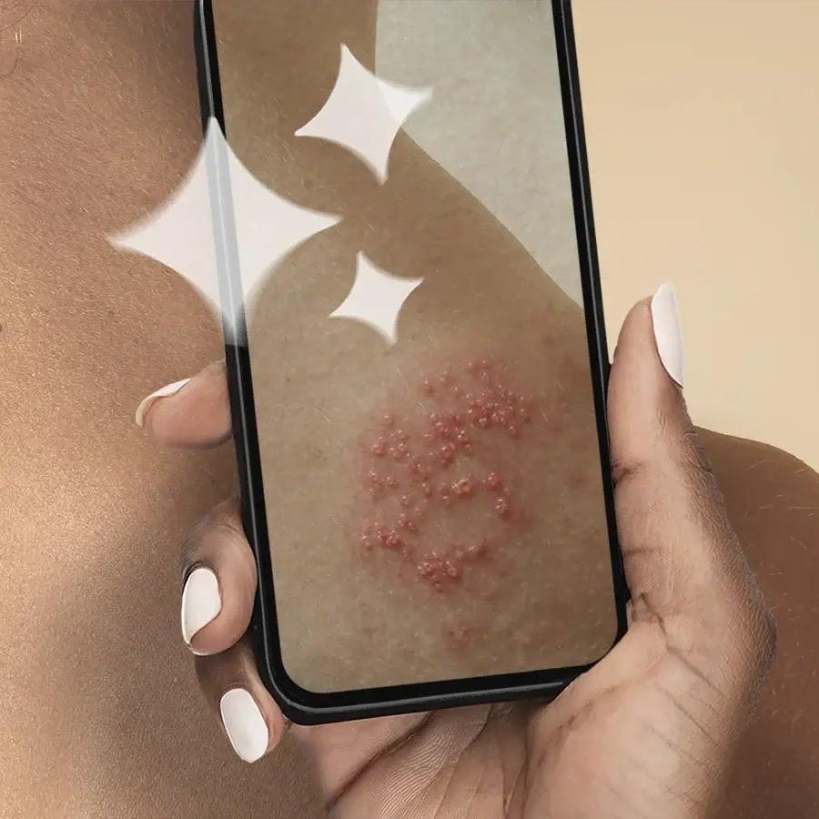 A smartphone showing a skin condition with reddish patches, held in front of a bare shoulder