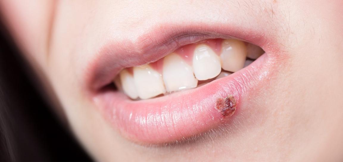 can you get herpes from a cigarette sharing Can You Get Herpes or HPV from a Are Cold Sores Contagious? A