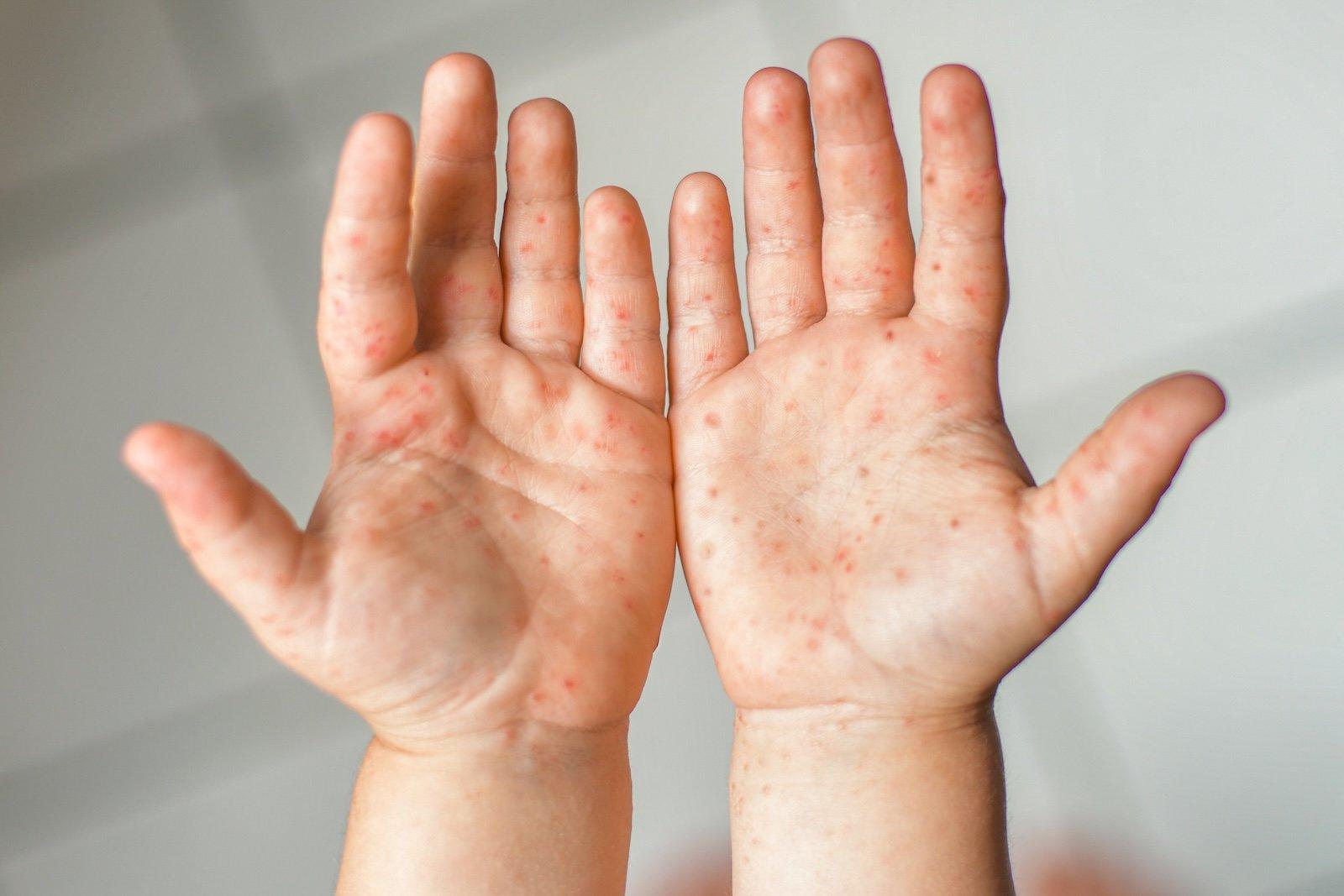 What is hand, foot & mouth disease? - Boot Health Hub
