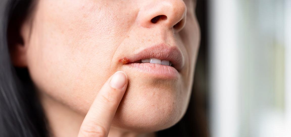 Close-up of a person touching a cold sore on their upper lip.