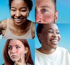 Collage of portraits of four individuals with freckles against a blue background
