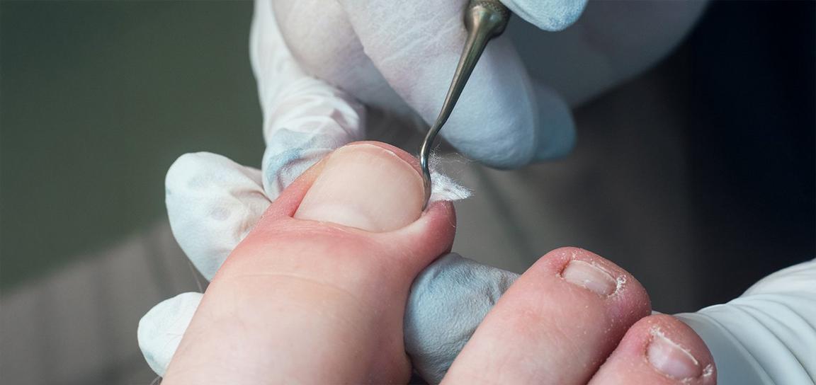 Moccasin athlete's foot: how to treat stubborn infection