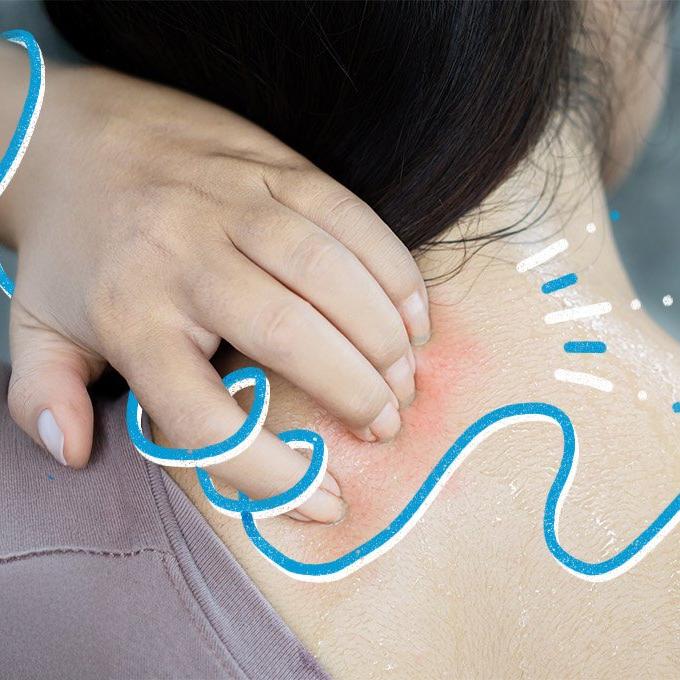 A hand scratching an irritated, red patch of skin on the back of a person's neck. Blue and white illustrative lines overlay the image