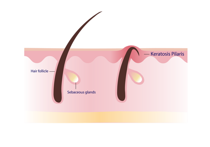 glutathione for keratosis pilaris Can Glutathione Help Keratosis Pilaris? Understanding the Connection 25% Vitamin C + Glutathione