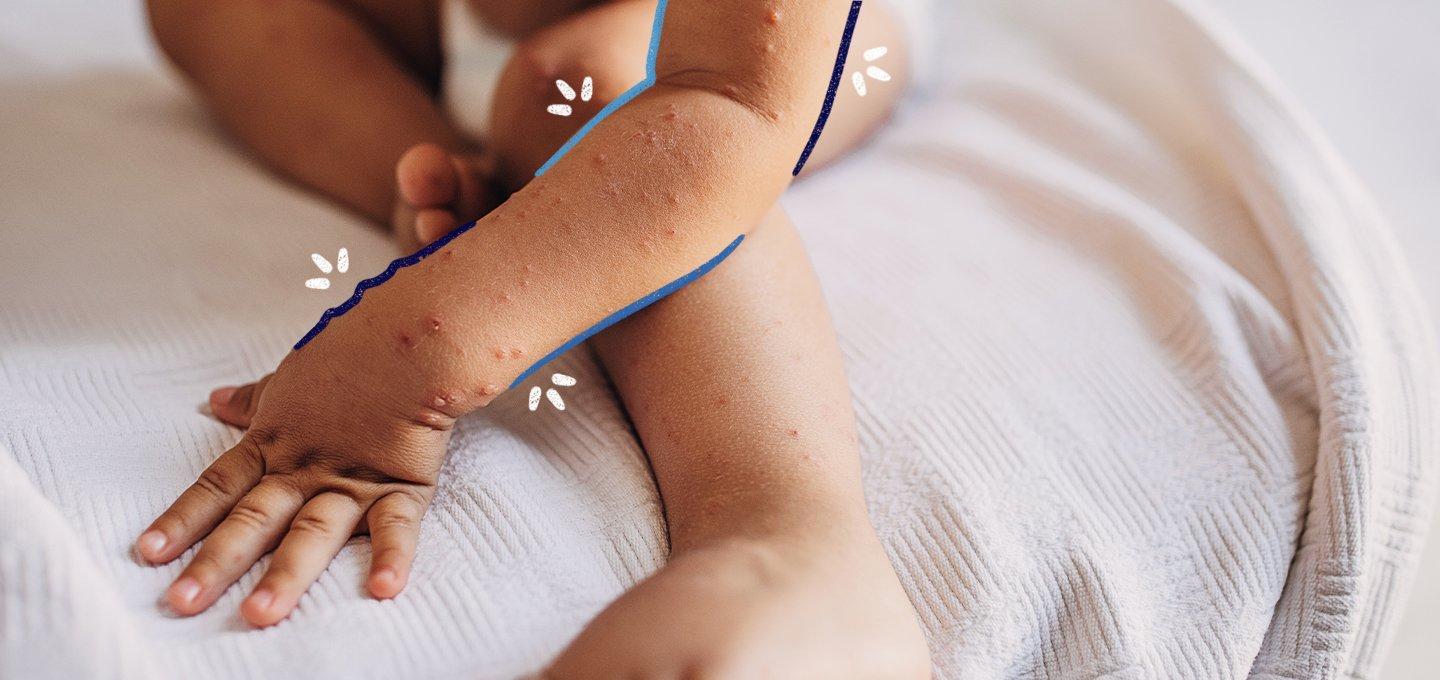 A guide to measles, mumps & rubella (MMR) | Boots