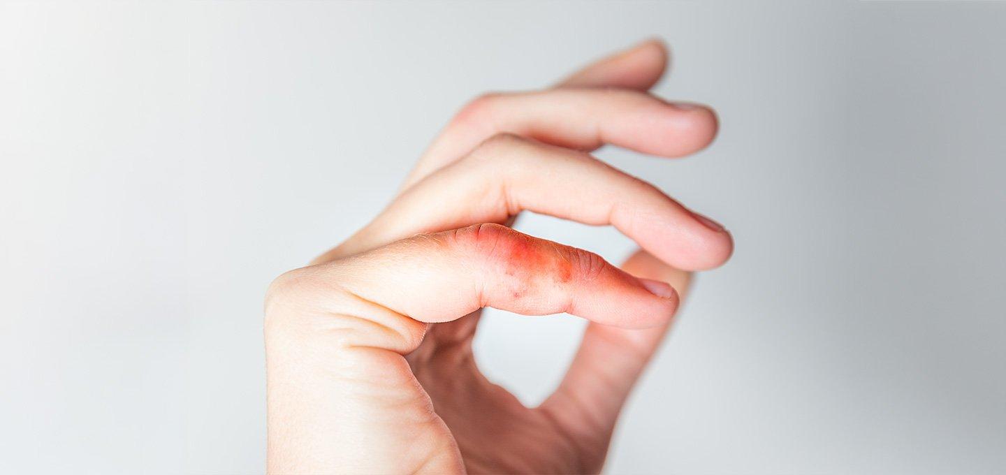 Close-up of a hand with a red, irritated patch on the finger joint.
