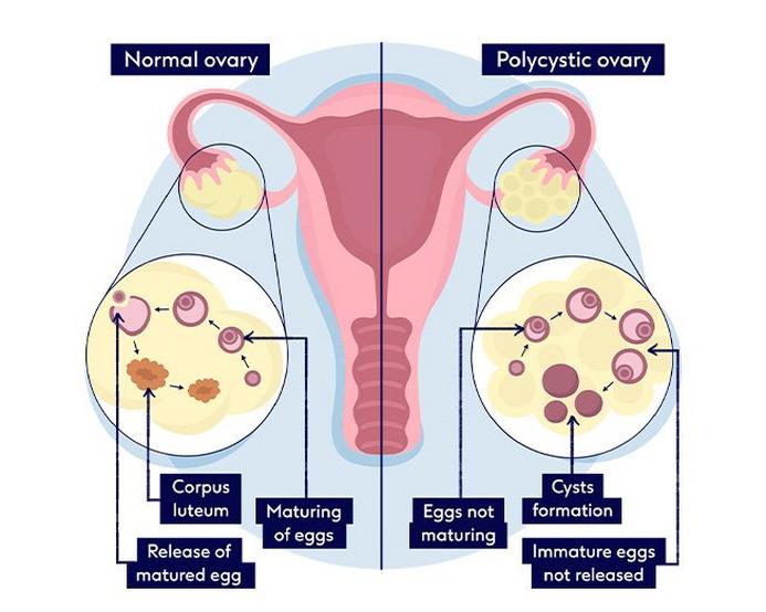 when to take l carnitine for pcos PDF) Regulatory Functions of L-Carnitine, Acetyl, and Propionyl L-Carnitine  in a PCOS Mouse Model: Focus on Antioxidant/Antiglycative Molecular  Pathways in the Ovarian Microenvironment main image 1