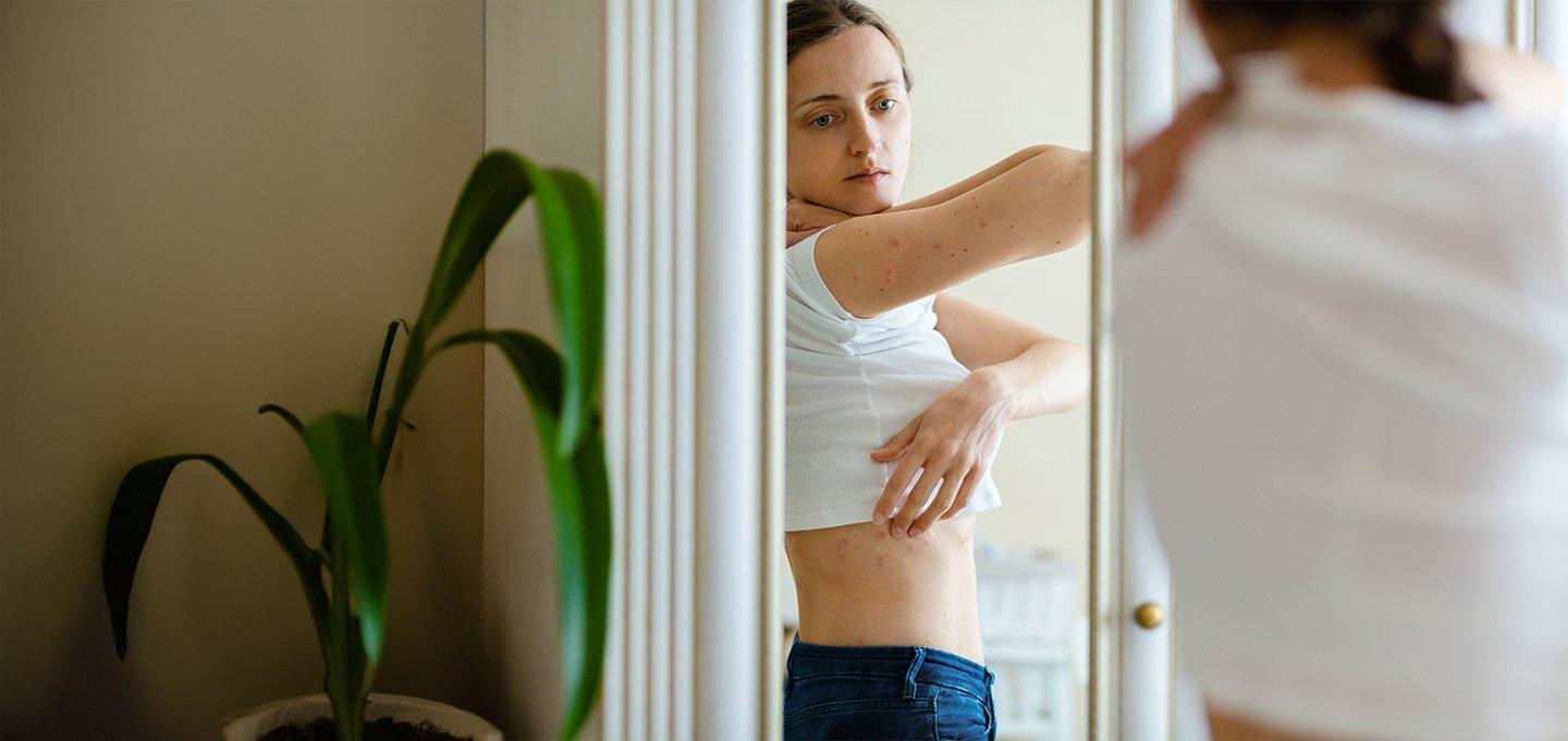 A person looking at their eczema on the side of their body in a mirror