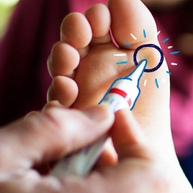A verruca on somebody's foot