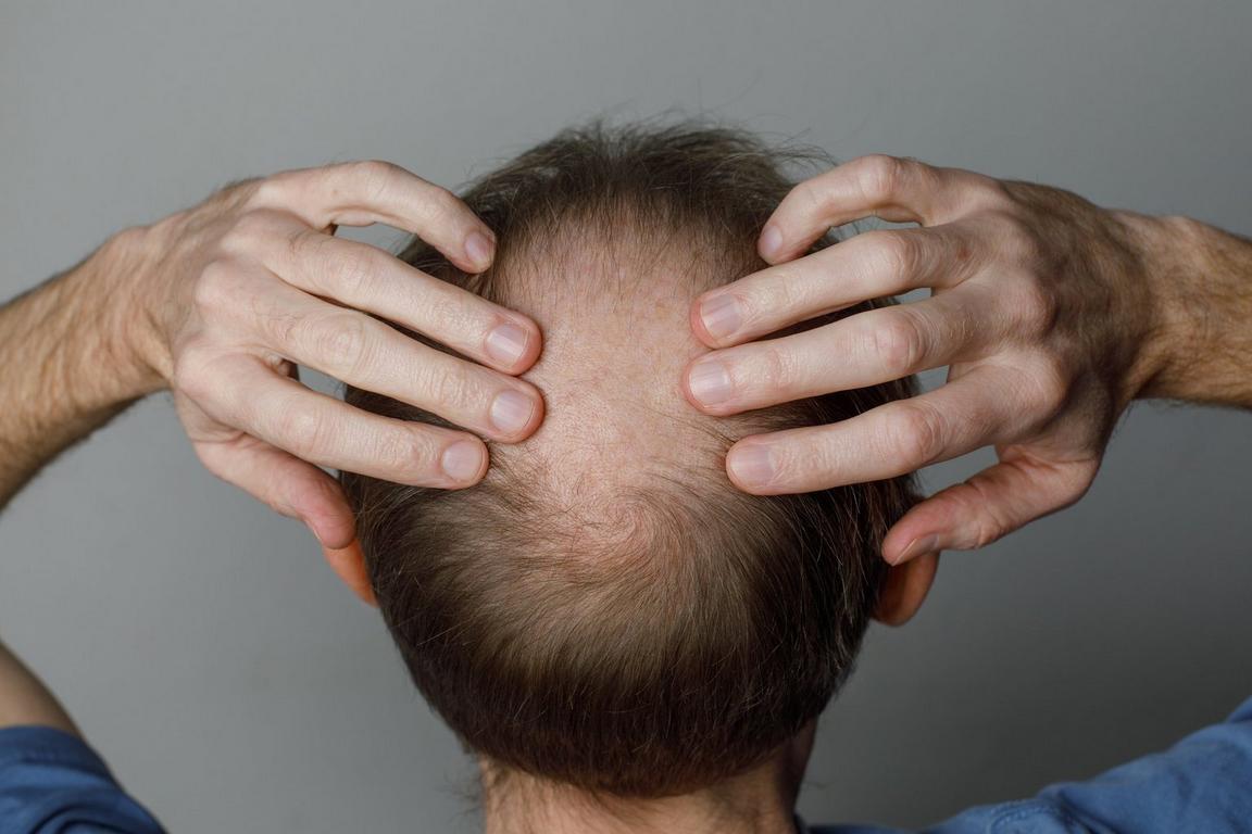 What is alopecia?